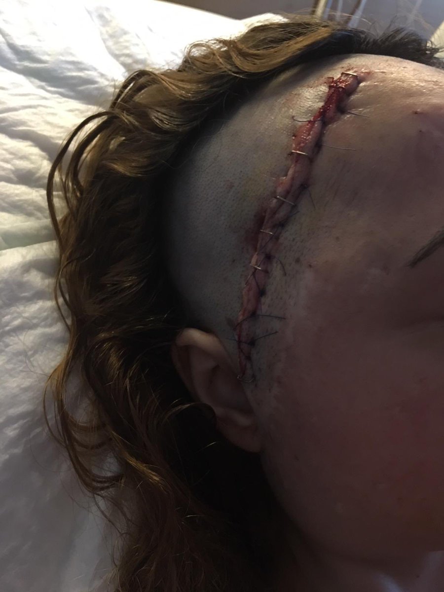 18.tümör ameliyatı olacak kız kardeşim için yardım topluyoruz arkadaşlar.
Her 6 ayda bir yapılması gerekiyor ve sürekli ürüyor maalesef ...