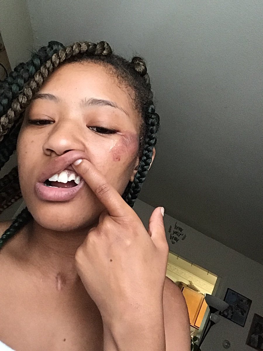 DaMonkeyBaby's tweet photo. My so called friends left me for dead in Stamford last night after a brunch date.... I legit woke up in Stamford hospital to restraints and bandaids where I was injected with morphine to put me to sleep. And still No one has answers for me smh. Be careful y’all https://t.co/zvuX5irq3Y