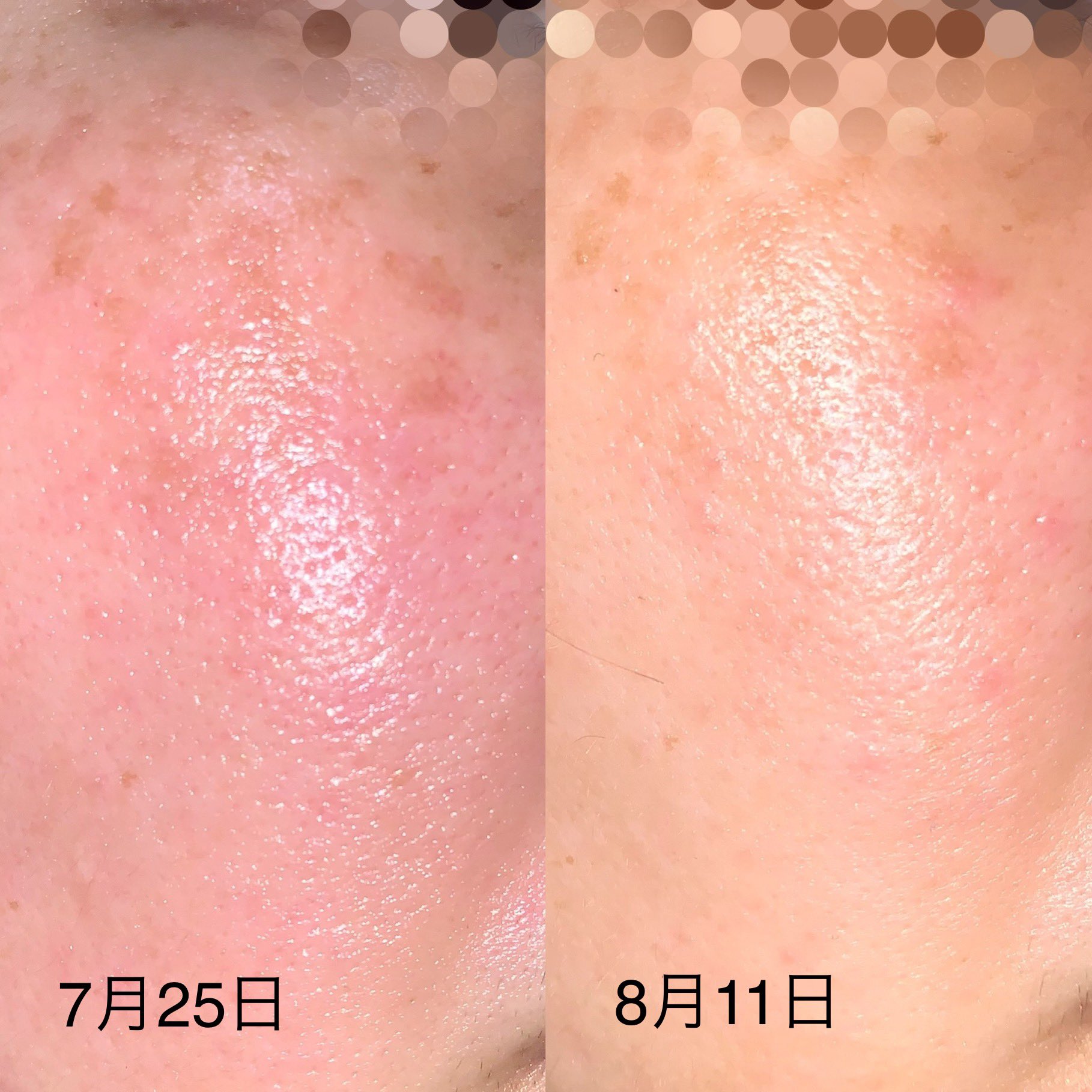 お爪 美容っぽい垢 汚肌画像注意 どうなったかな とういことで ベビーオイル洗顔始めた日と今さっきの比較写真 初日 めちゃめちゃ赤い 笑 さっき 赤みもかなり消えて毛穴も若干気にならなくなっている感じ 私は 洗いすぎ擦りすぎ保湿し
