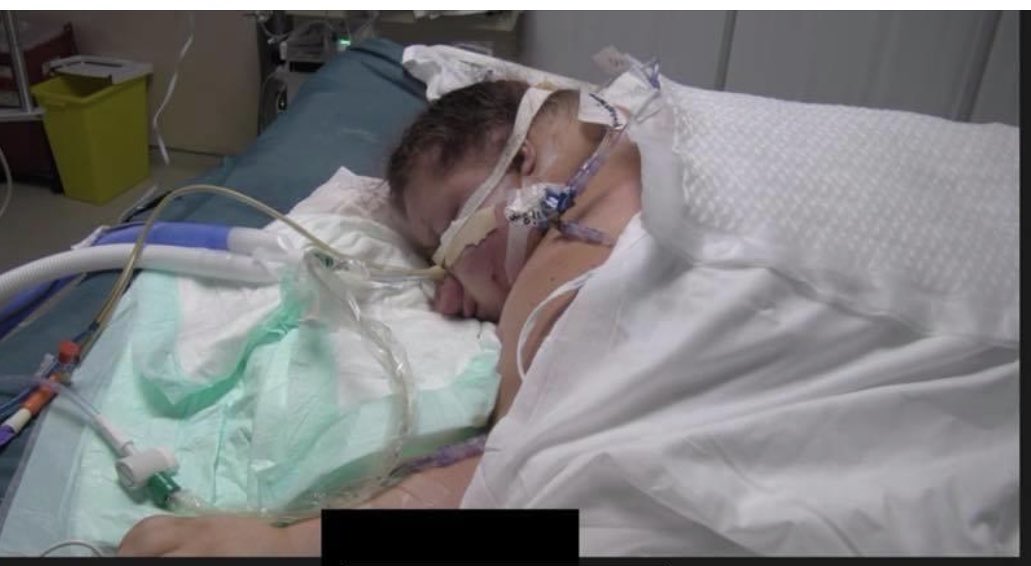 Update on Chloe: 8/10 
Still sedated. They had 2 go back ⬆️ 2 100% use of the ventilator last night. Her Peep is set to 18 because she had a coughing fit. BP is a low, her temp spiked to 103 &amp; her sugar was at 183. Her tongue is very swollen. She now has staph in her lungs.
