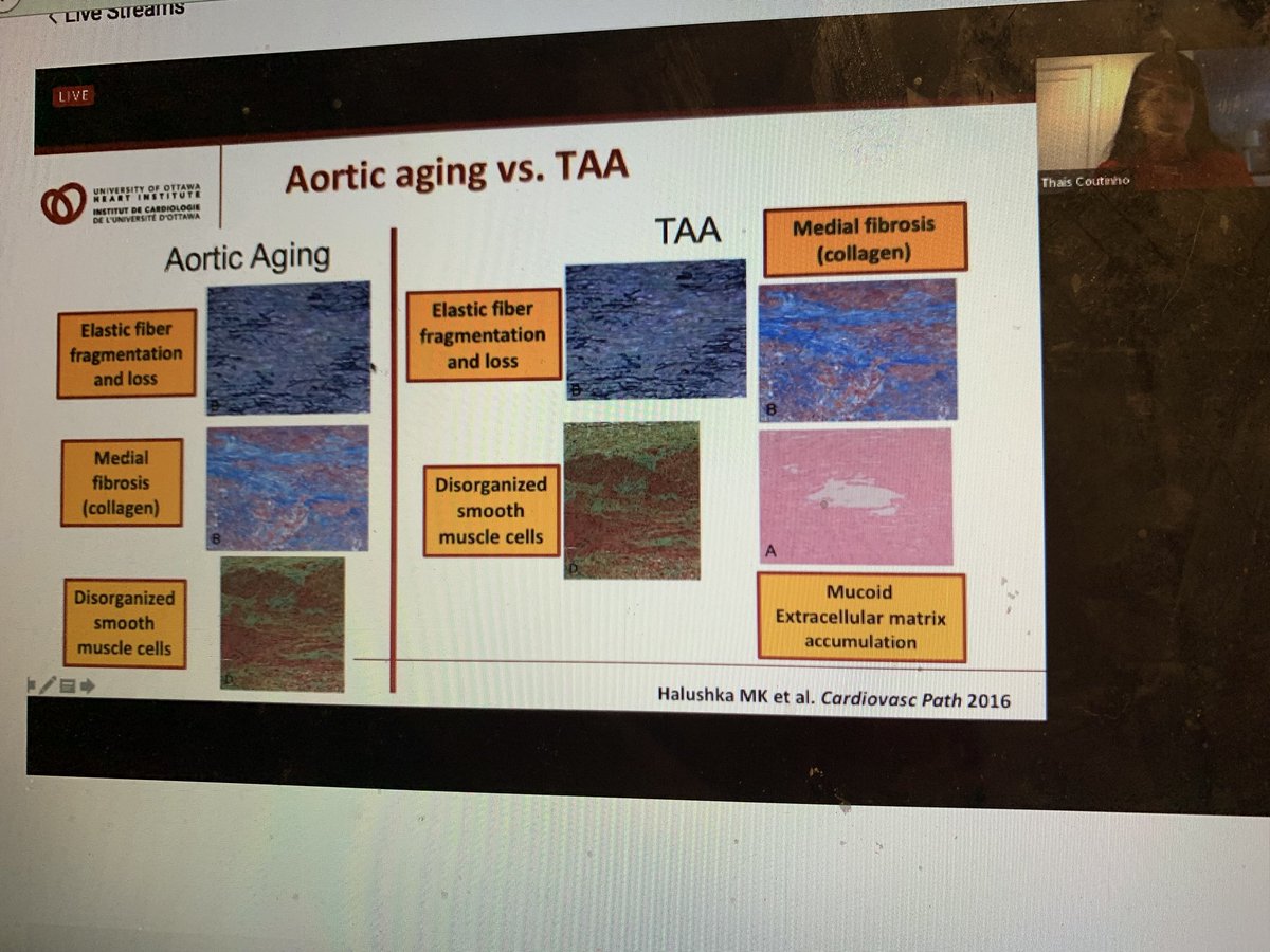 thaiscoutinhoCV's tweet photo. My talk at @ASE360 #ASE2020: TAAs share similar structural abnormalities with aortic aging. Assessing aortic function/ hemodynamics/ aging helps understand #TAA disease activity and sex differences in #TAA! #NotJustAPipe @HeartInstitute https://t.co/A3dwgExjHq