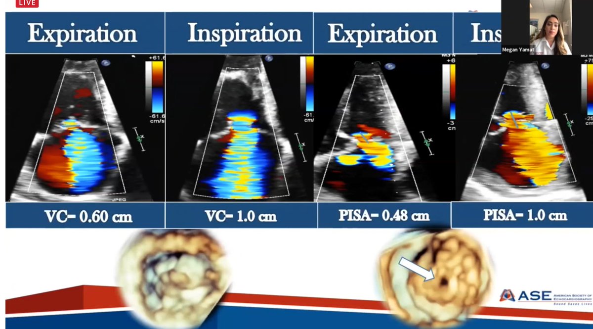 AkhilNarangMD's tweet photo. Megan Yamat presenting her research on respiratory dependence on severity of TR. Should we measure at end-inspiration? Excellent and timely information that has important implications for management. Plus we got to see @robertomlang's TV while he snored! #ASE2020 #EchoFirst https://t.co/ihjqApDbkj
