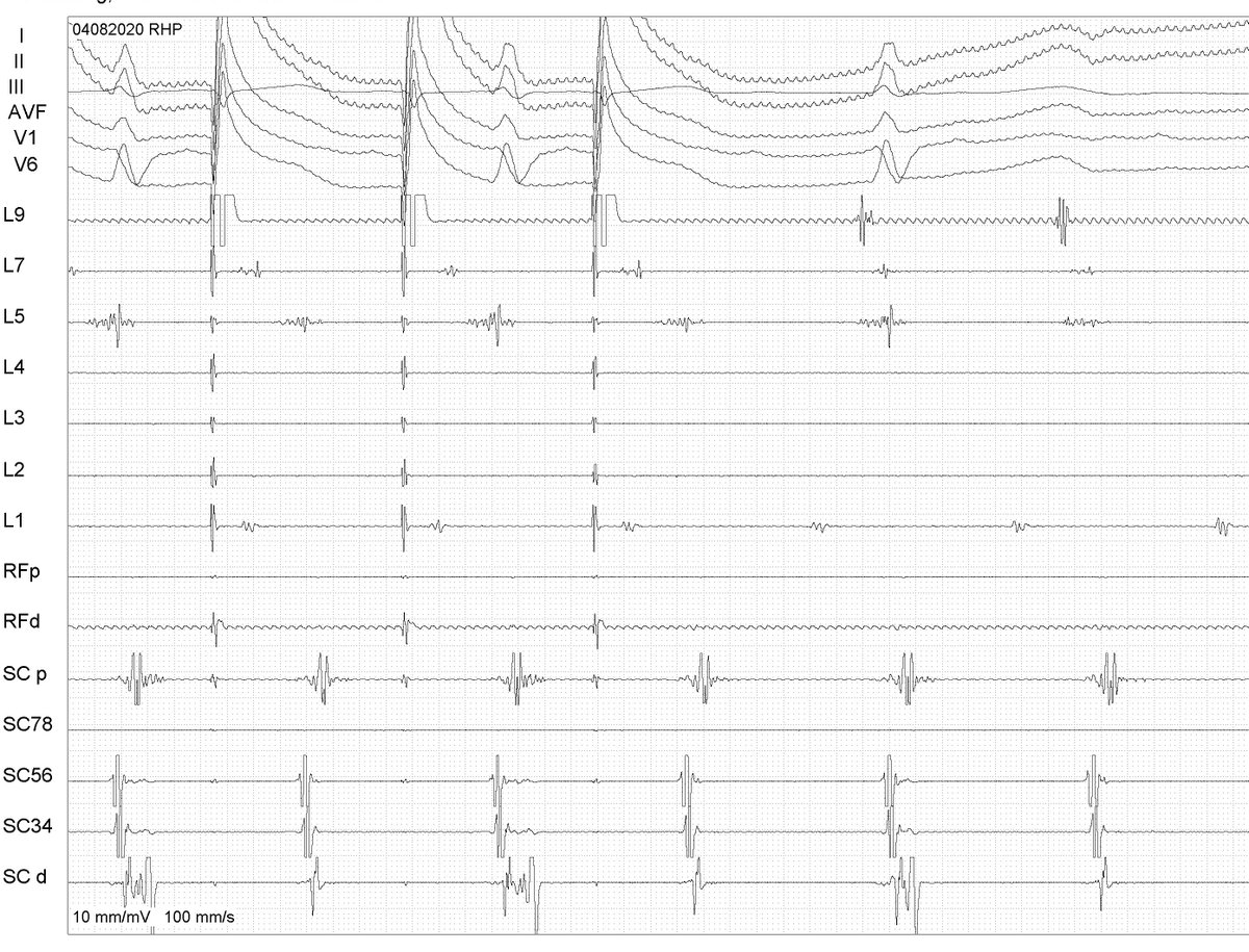 63 yom, previous AF ablation 10 years ago, did PVI + CTI ablation. Now presents with atypical LA flutter. Try to do entrainment on the roof of LA, but the diseased myocardium showed a long PPI at that location.