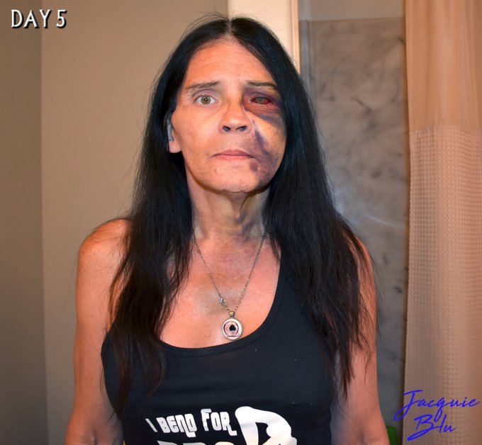 FACIAL UPDATE: (Sounds naughty, doesn't it?)  DAY 5  Thanks to all my friends &amp; fans for all the love<a href="/tag/jacquieblu"class="tags"><span>#jacquieblu</span></a><a href="/tag/bludreamz"class="tags"><span>#bludreamz</span></a>