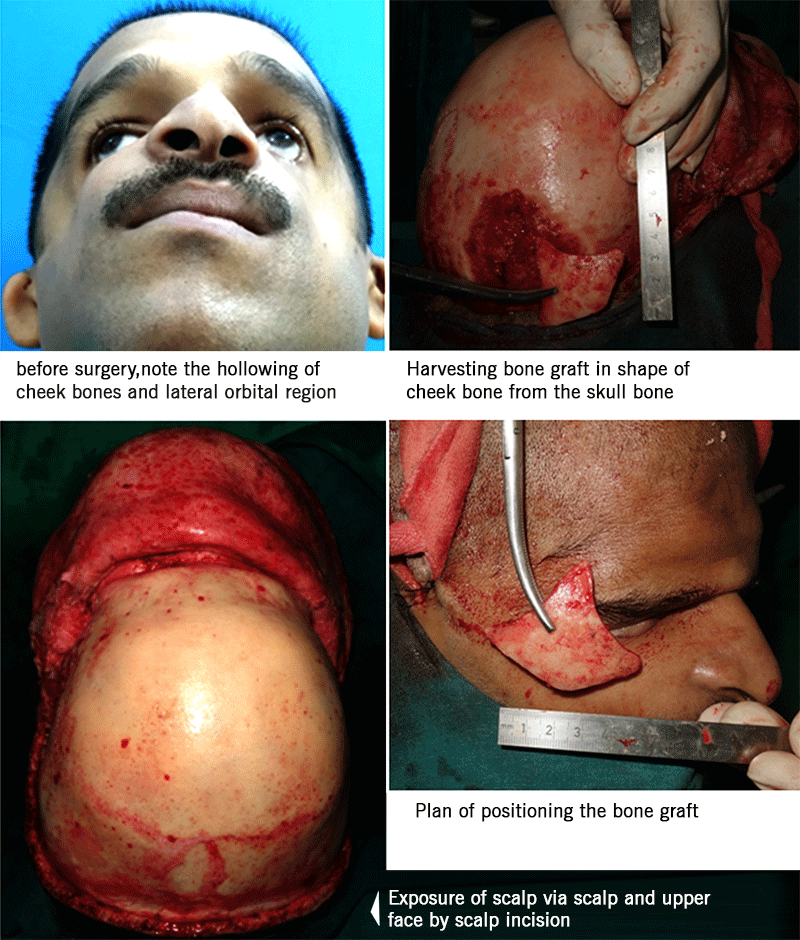 AndeiSoI's tweet photo. Treacher Collins syndrome (TCS) -a genetic disorder with deformities in ears, eyes, cheekbones, and chin #facedeformities #MedTwitter #maxfax #MedEd #Drsunilrichardson #lovemyjob #positivity #facesurgery https://t.co/F0qQ9w7KG1