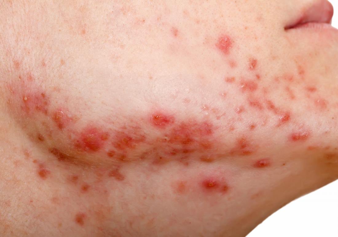 WHAT IS HORMONAL ACNE?Many of you have requested this particular topic. Hormonal acne tak sama macam jerawat biasa. Just like its name, hormonal acne berkait rapat dengan our hormones.THREAD: Dazed & Medical News Today