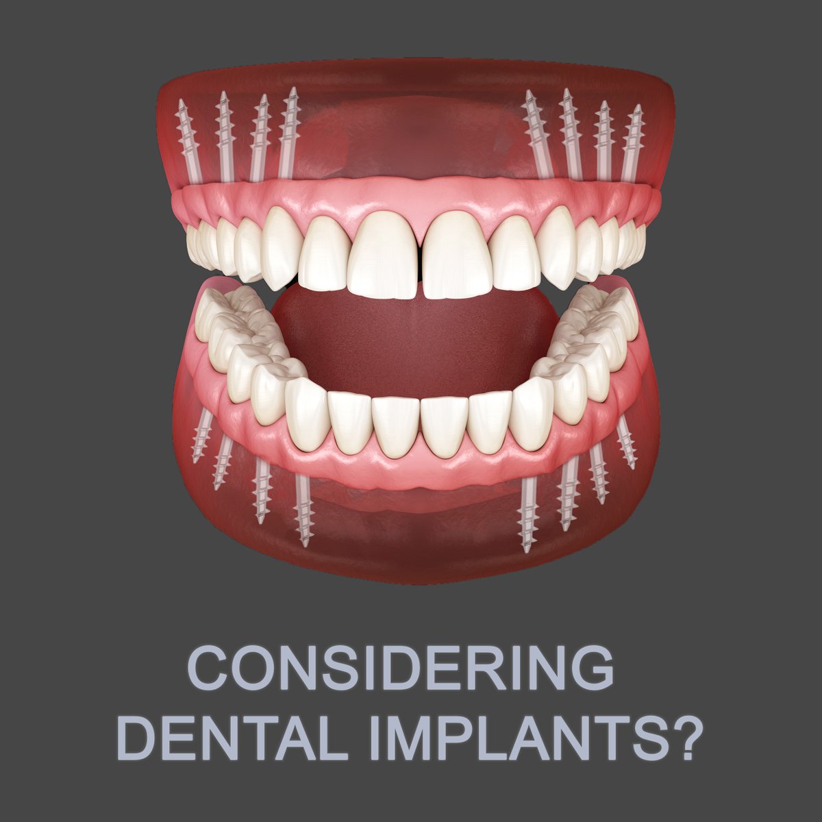 NuridentClinic's tweet photo. You need more information about dental implants? Call us for a FREE consultation at +447506401169 or visit our website https://t.co/Ltgl9ZGXib
#nurident #dentalimplantsurgery #dentalimplants #dentalimplant #immediateloading #basalimplants #compressiveimplants https://t.co/Q2pN0EhIvP