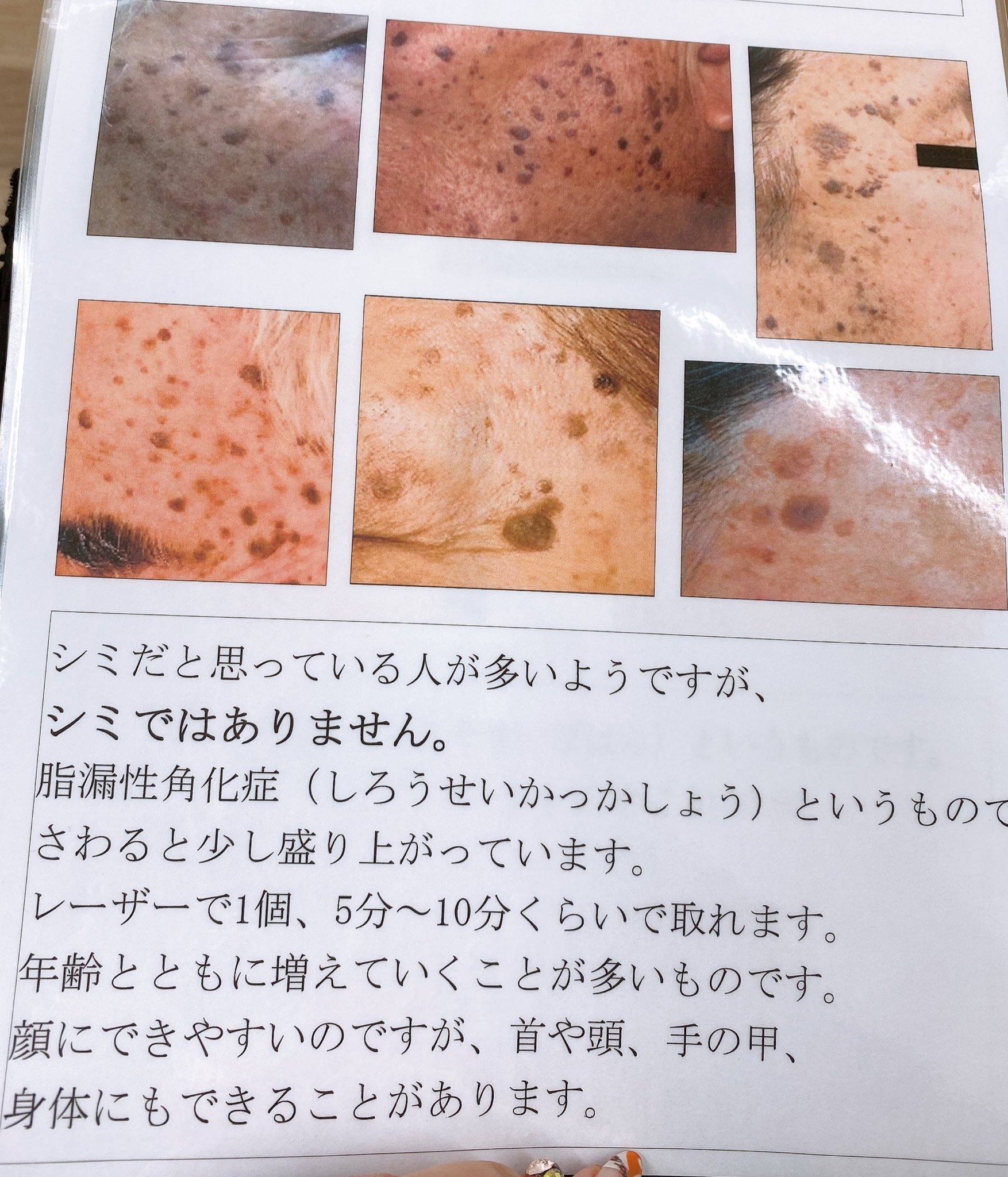にゃむこ 6m 今日行った皮膚科にあった保険で取れるものの種類 ほくろに見えてもいろんな種類があるから病院選びは慎重に 私はお腹にできてた小さいぶつぶつ ホクロかな って思ってた が まさかの脂漏性角化症の疑い 小さいから検査