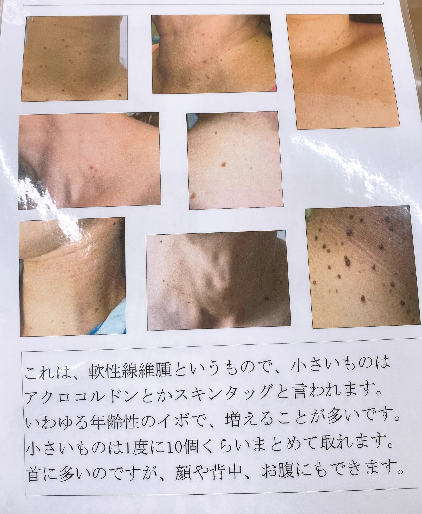 シミやほくろだと思ってた？皮膚科に行くと保険で取れるものもある！