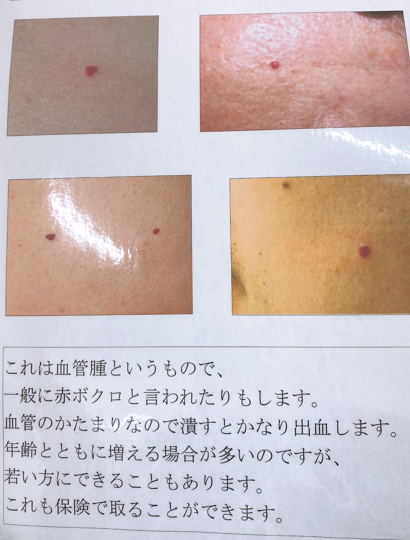 にゃむこ 6m 今日行った皮膚科にあった保険で取れるものの種類 ほくろに見えてもいろんな種類があるから病院選びは慎重に 私はお腹にできてた小さいぶつぶつ ホクロかな って思ってた が まさかの脂漏性角化症の疑い 小さいから検査