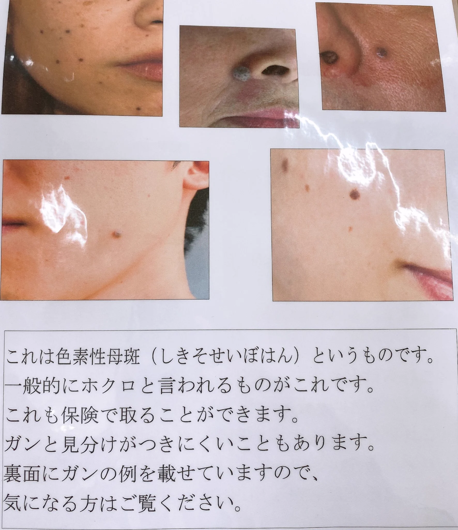 シミやほくろだと思ってた？皮膚科に行くと保険で取れるものもある！