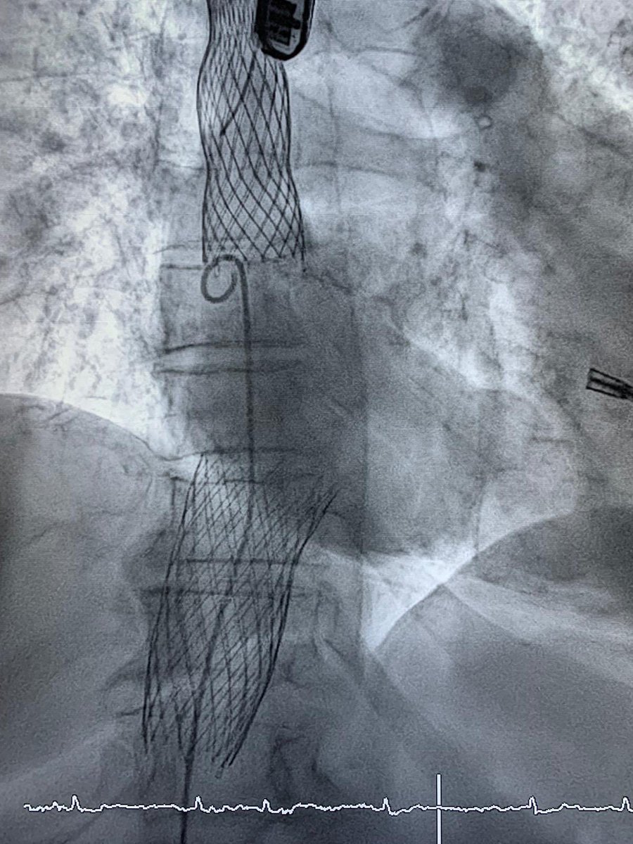 ramirotrillo's tweet photo. Second successful case of #Tricvalve bicaval prosthesis implantation in patient with previous #Mitraclip and severe tricuspid regurgitation. Thanks to Dr. Omar AJ for your useful advises @shci_sec @belcid7 @birihh @xoansanmartin @VioletaGSalvado  @MonzonisAmparo @cardiologiaCHUS https://t.co/Y9pFMyHcxq