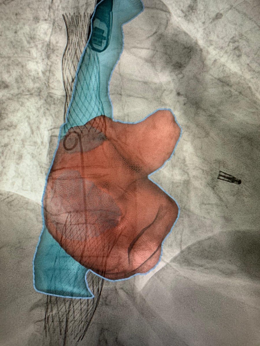 ramirotrillo's tweet photo. Second successful case of #Tricvalve bicaval prosthesis implantation in patient with previous #Mitraclip and severe tricuspid regurgitation. Thanks to Dr. Omar AJ for your useful advises @shci_sec @belcid7 @birihh @xoansanmartin @VioletaGSalvado  @MonzonisAmparo @cardiologiaCHUS https://t.co/Y9pFMyHcxq