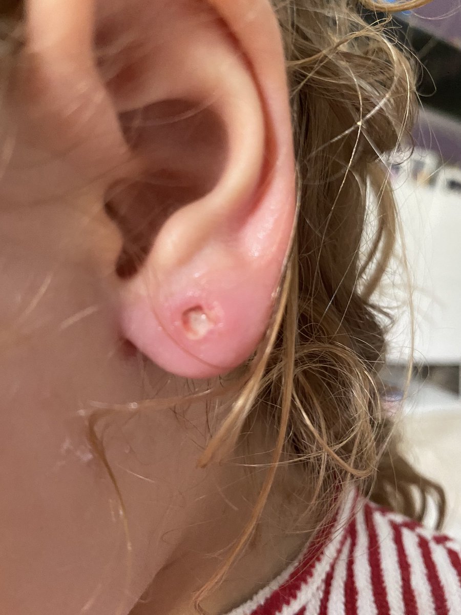 Bea_CSIC's tweet photo. Después de comprar unos pendientes en la tienda de @DisneyPlanta9 en Madrid y que mi hija los llevase 5 dias puestos así han acabado sus orejas. Hemos tenido que acudir al servicio de urgencias y va a necesitar antibiótico y curas durante varios días. https://t.co/ZwGMaRrWA1