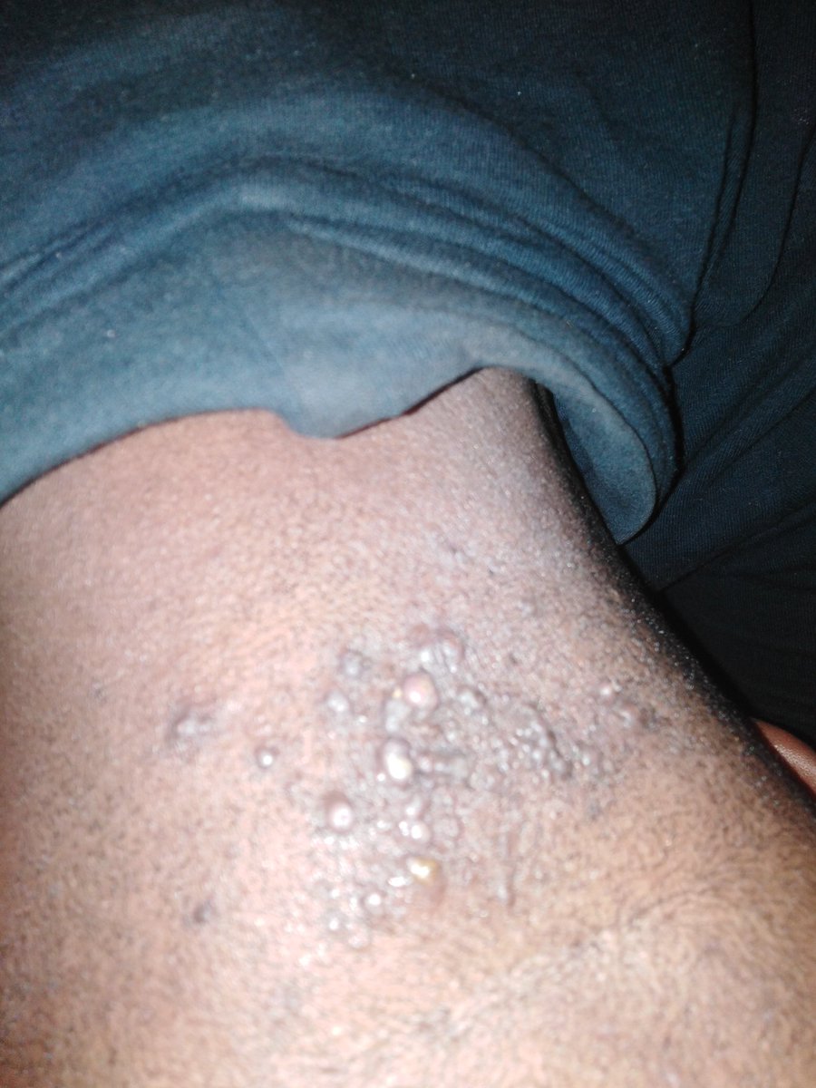LeeLinduyise's tweet photo. Anyone who can tell me what causes this? I've had it since I was 11. I'm turning 23 this year. My father had it and some of my relatives have it. Please help, I want to get rid of it. @SkindoctorsSA @Herbalife @akreana_ #ojewakeng @LungiManyama @drbusani1 @thaba_sam https://t.co/B9l5mvOu7p