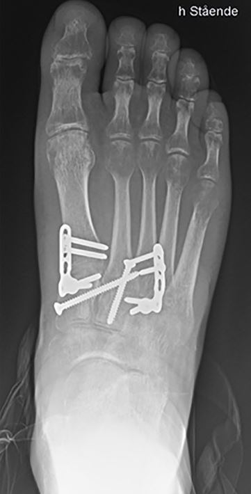 AOFAS_Journals's tweet image. In this randomized controlled trial on Lisfranc injuries, bridge plating is compared to primary arthrodesis of the 1st TMT joint. The 2nd &amp;amp; 3rd TMT joints were fused in all patients. No method was found to be superior in regards to the AOFAS midfoot score. ow.ly/IFcu50AWqOq