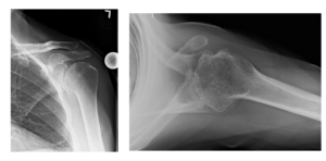 MillettMD's tweet photo. An alternative to #totalshoulderreplacement is #jointpreservation arthroscopic surgery for the #shoulder. https://t.co/SEt1fhGCXm https://t.co/mpdR5XTj65