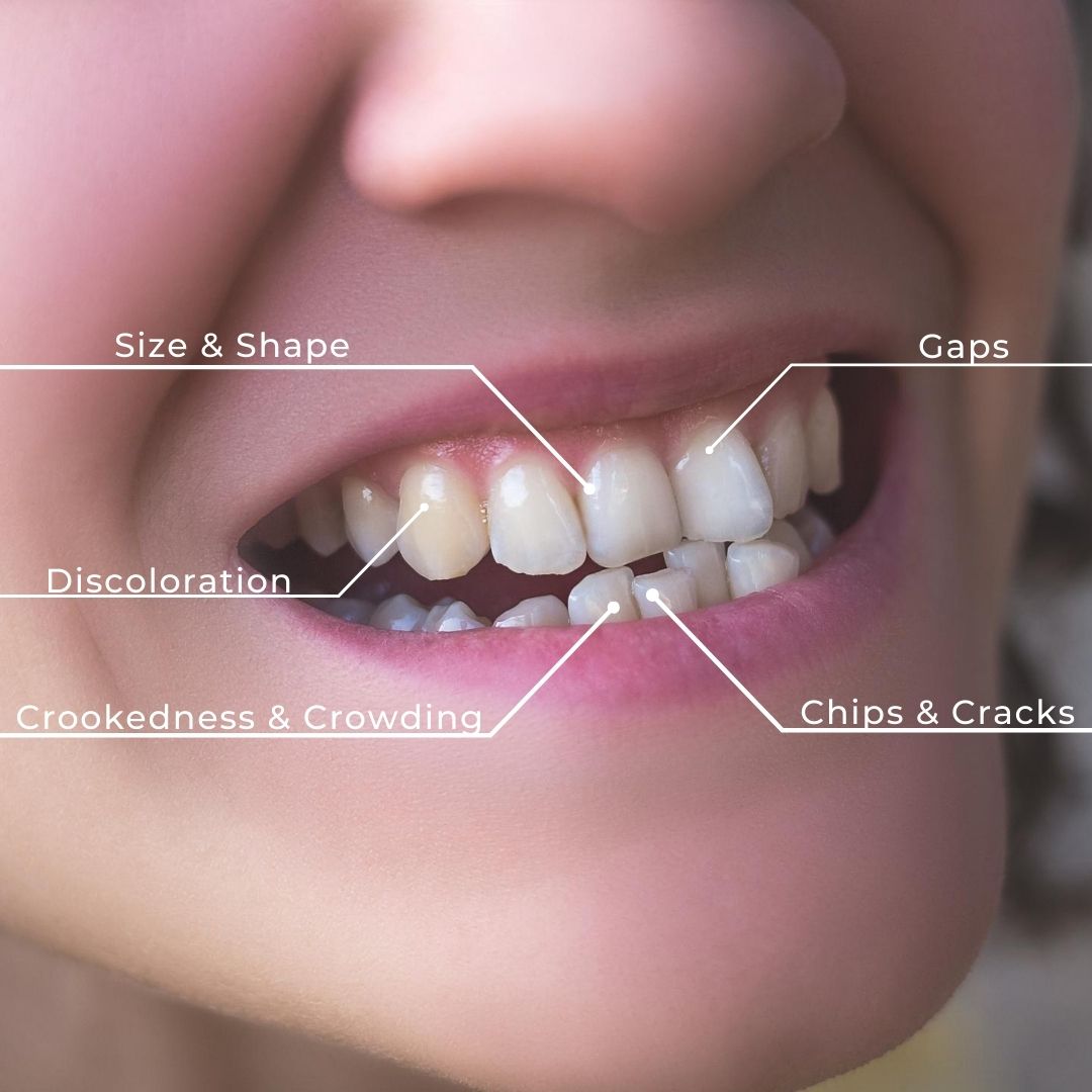 Cosmetic dentistry can address the most common concerns people have about the appearance of their smiles.

Learn more about cosmetic dentistry at drandreastevens.com/cosmetic-denti….
Start planning a smile you love, request a virtual consultation at app.smilevirtual.com/Dr-Andrea-Stev….

#OttawaDentist