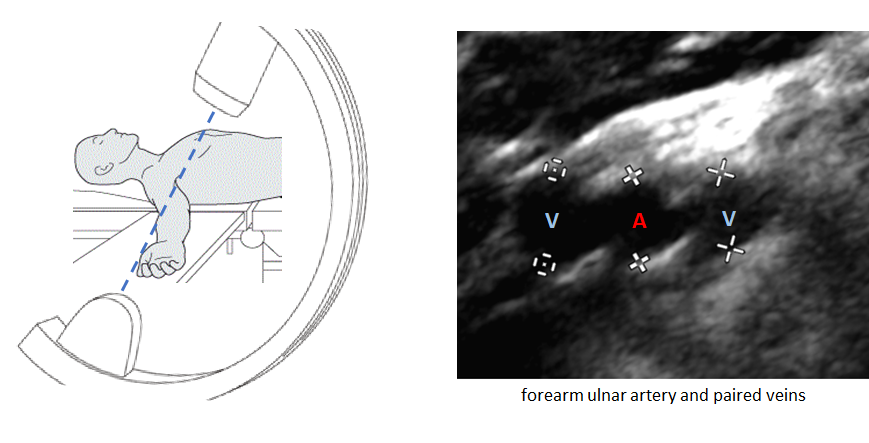 Example 2: CORRECTLY in widest view (see how the artery and veins are now all in plane?)
