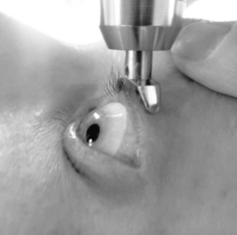 TONOMETER's tweet photo. How to measure Intraocular Pressure (IOP) #Safely? π
#IOP via EYELID. NO Need to take Contact or Scleral Lenses Out.
ZERO CONTACT with #CORNEA.
More at https://t.co/LGm9aYOiWo
#optometry #ophthalmology #glaucoma #diaton #eyecare #SafeTonometry #transpalpebral #eye #eyes https://t.co/Kbznq9Ibty