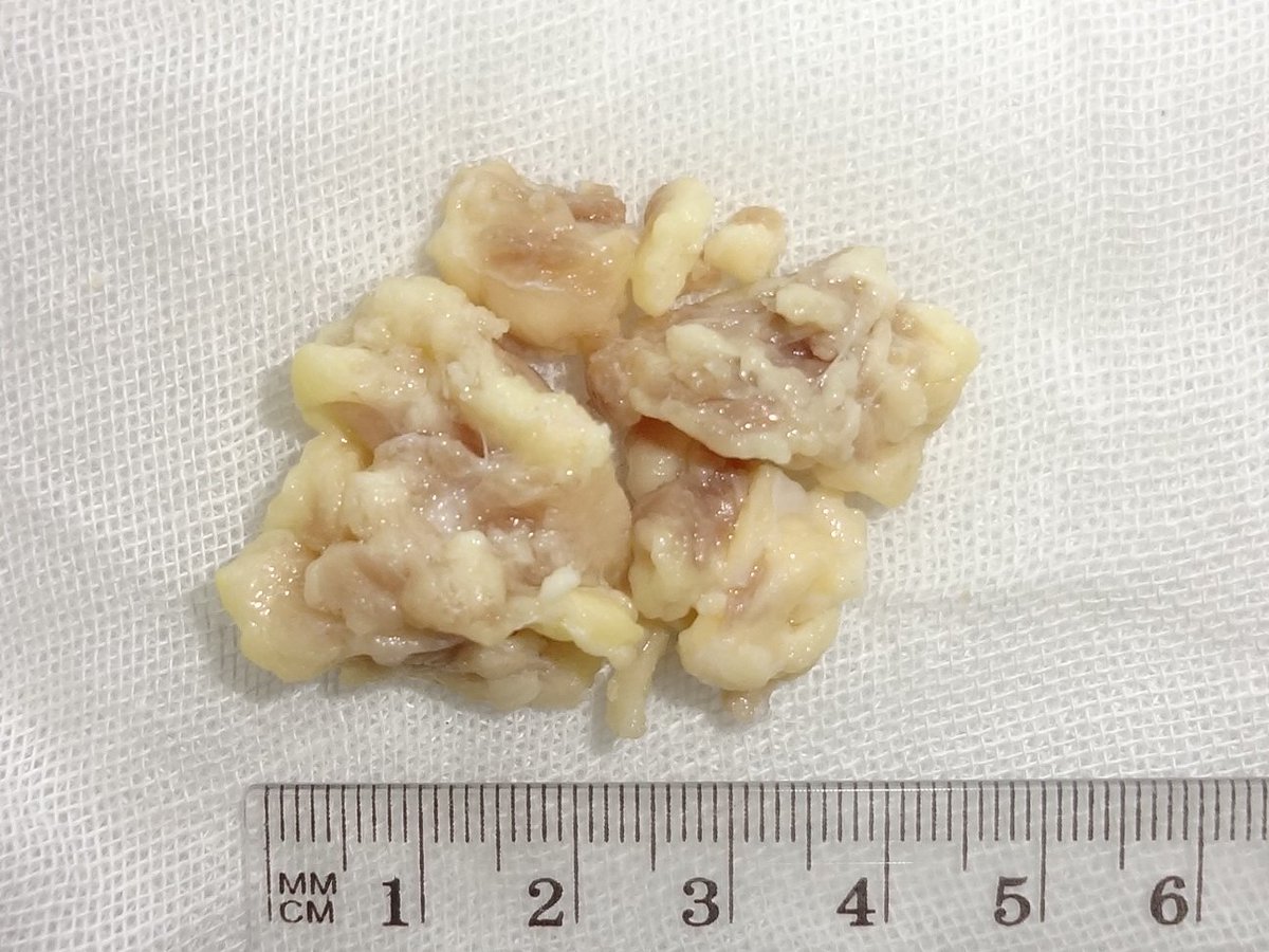 1/5  #Pedipath  #BSTpath Early Adolescence. Boy. Multiple soft tissue masses  @mreyesm  @MArnold_PedPath  @marenwhymd  @AmyHDeekenMD  @dinesh_rakheja  @histiocytosisX  @emckaymd  @ERDENEROZER  @vhnguyenmd  @TristanRutland7  @JMGardnerMD  @ariella8  @martiponi  @ScottBikeethan