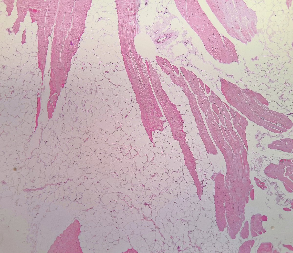 2/5 Over 95% of the resected tissue shows histology like this 