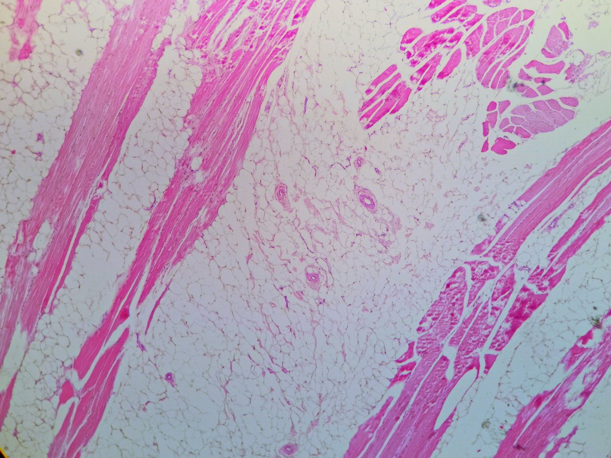 2/5 Over 95% of the resected tissue shows histology like this 