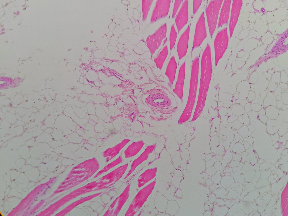 2/5 Over 95% of the resected tissue shows histology like this 