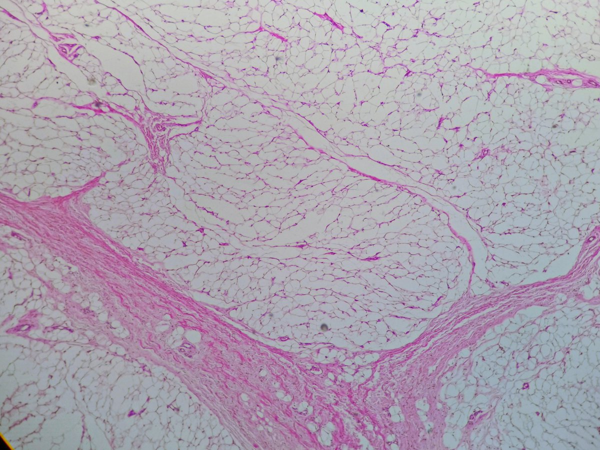 2/5 Over 95% of the resected tissue shows histology like this 