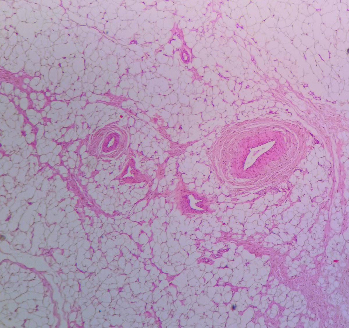3/5 I reported this as intramuscular hemangioma b4 the orthopedic surgeon showed me the clinical picture and asked me to review the histology.... Then i looked back at the histology and said to myself what kind of vessels are these! They are not compatible with ordinary lipoma