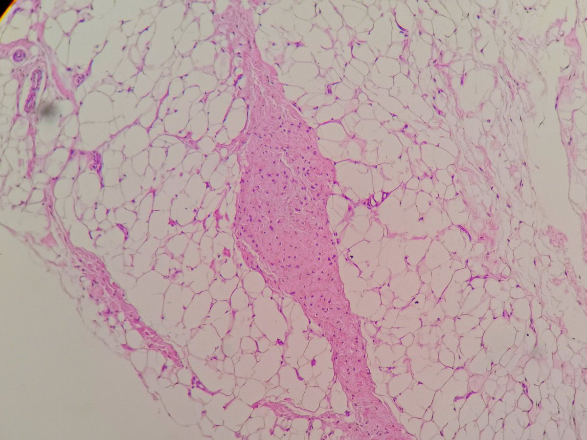 3/5 I reported this as intramuscular hemangioma b4 the orthopedic surgeon showed me the clinical picture and asked me to review the histology.... Then i looked back at the histology and said to myself what kind of vessels are these! They are not compatible with ordinary lipoma