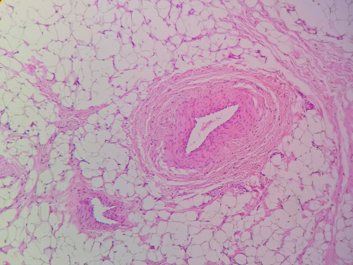 3/5 I reported this as intramuscular hemangioma b4 the orthopedic surgeon showed me the clinical picture and asked me to review the histology.... Then i looked back at the histology and said to myself what kind of vessels are these! They are not compatible with ordinary lipoma