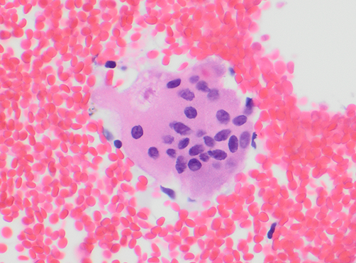 gildasantoscyto's tweet photo. LN EBUS-TBNA. Sarcoidosis. Not as photogenic as the constellation of @JMGardnerMD !! ππ #Cell_block #asteroid body #Cytopath #Cytopathology #LNpath #pathresidents #pathologists https://t.co/UHKX7O5P8x