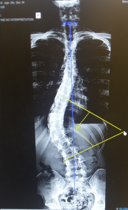 4/Scoliosis. It's not coincidence I start here. It's the least invisible, and I'm already self conscious of the skeptical thoughts that will arise in ppl if I start with a disability that I can't provide visual evidence for!I have ~55° scoliosis curve. Relatively significant: