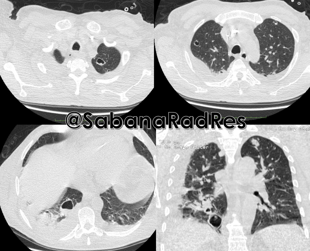 SabanaRadRes's tweet photo. ...posteriormente es llevado a sesión de hemodiálisis. Durante la estancia hospitalaria presenta deterioro clínico dado por síntomas respiratorios, taquicardia y fiebre. Paraclínicos: leucocitosis y PCR elevada.
#Radiology #FOAMrad #SabanaRadRes #RadCase https://t.co/lEX3qAm0cr