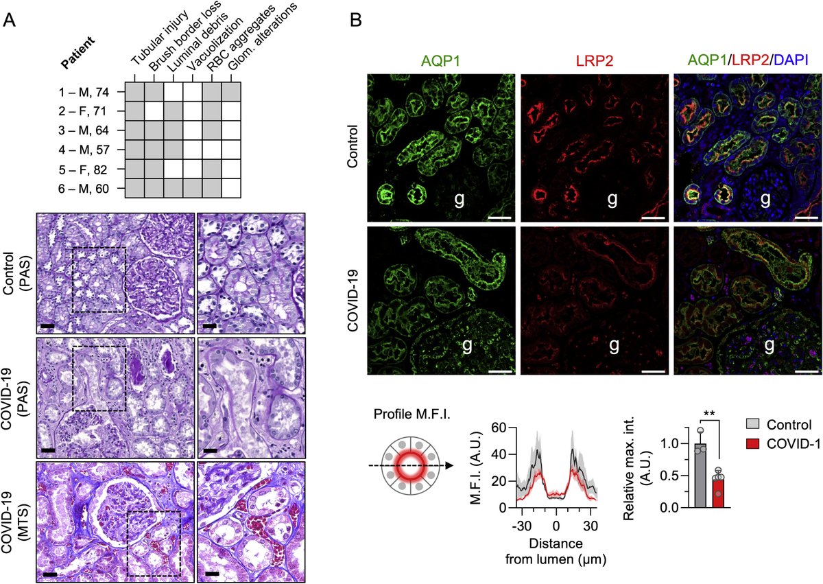Kidney_Int's tweet photo. #SARSCoV2 Induced Proximal Tubular Dysfunction
https://t.co/AcFAzKfesf
@JohannMorelle @AlexisWerion⁩ @LeilaBelk @UCLouvain_be @ClinUnivStLuc @frsFNRS https://t.co/h8jbZ8fMsp