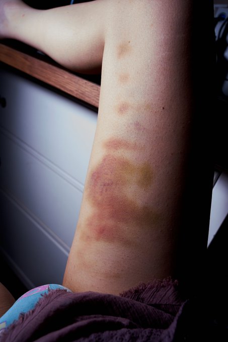 400 cane strokes a day later.  I'm not sure exactly how many I took on this thigh.  Maybe 150?  It's