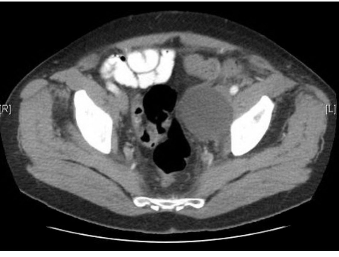 JMichaelBarraza's tweet photo. Recurrent lymphocele after prostatectomy with pain, nerve palsy. Drain placed. Nodal lymphangiogram: leak, drained by catheter. Nodal embo: no more leak. No more drain. @itkinmax @SIRRFS @IRAngioClub https://t.co/SjZZ5XqyfG