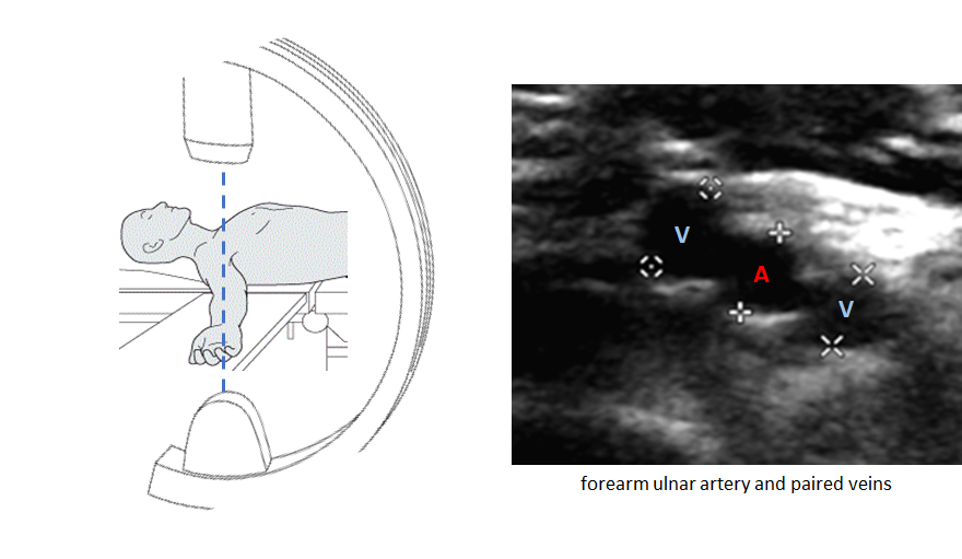 Example 1: NOT in widest view (vessels will be a bit overlapped in the 2D fluoro image)