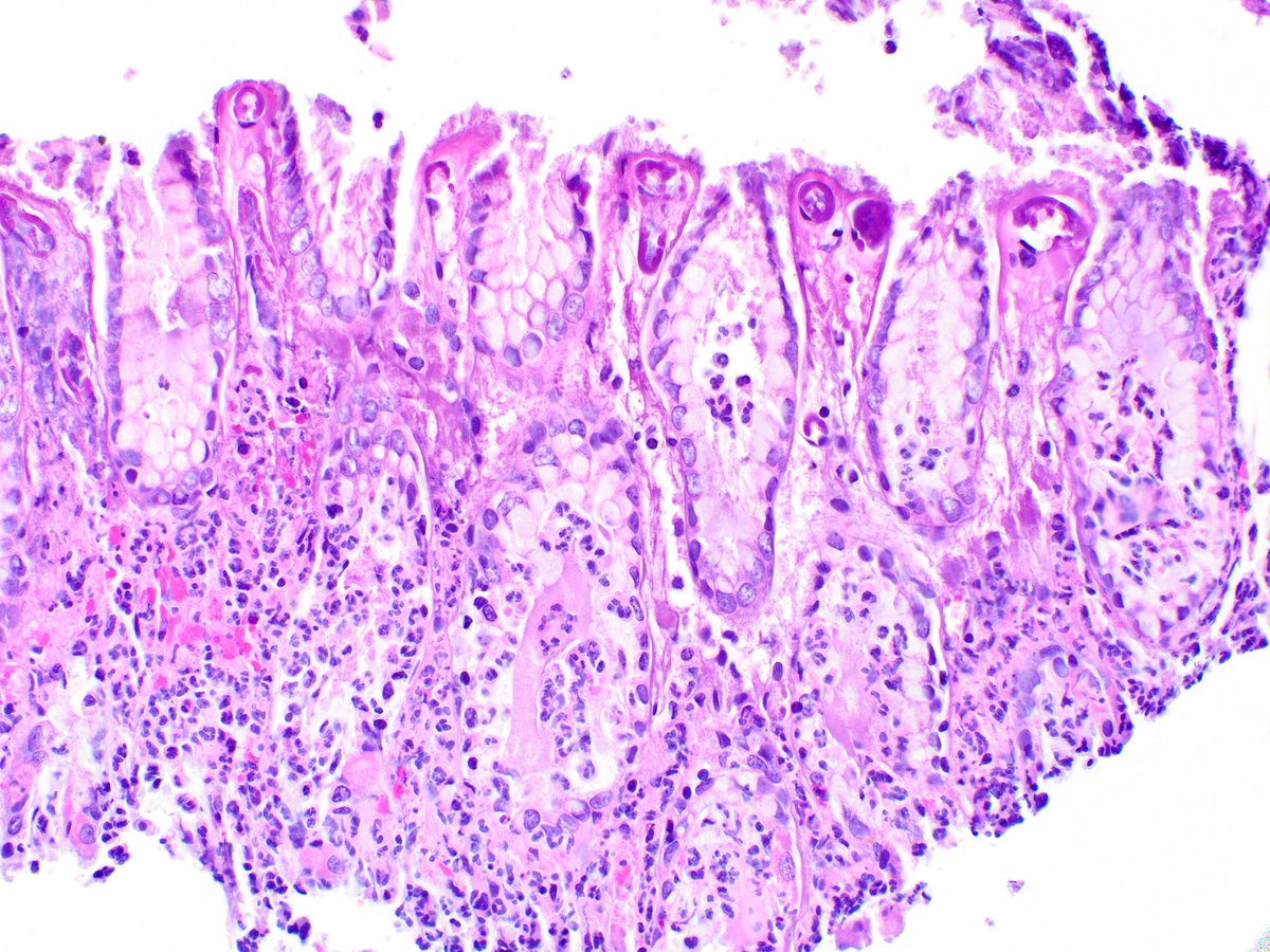 Gastric injury associated with doxycycline.  Note the peculiar fibrinoid change, described by colleagues.
Xiao SY, Zhao L, Hart J, Semrad CE. Gastric mucosal necrosis with vascular degeneration induced by doxycycline. Am J Surg Pathol. 2013;37(2):259-263.