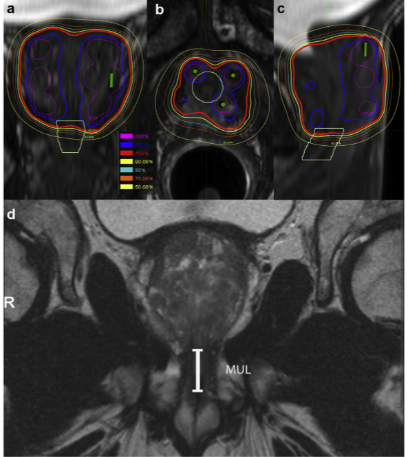 DrKamrava (@kamravamd) on Twitter photo ASCENDE-RT ⬆️GU tox w BT but ⬆️PSA control...
Option #1: give up on BT
Option #2: improve on BT tech
MARS - pubmed.ncbi.nlm.nih.gov/32682778/
Dose to EUS matters
<a href="/SJFrankMD/">Steven J. Frank, MD</a> <a href="/daniel_petereit/">Daniel Petereit</a> <a href="/PeteRossiMD/">Peter Rossi</a> <a href="/brettcoxmd/">Brett Cox, MD</a> <a href="/TimShowalter1/">Tim Showalter</a> <a href="/DrBMoran/">Brian J. Moran, M.D.</a> ASCENDE-RT ⬆️GU tox w BT but ⬆️PSA control...
Option #1: give up on BT
Option #2: improve on BT tech
MARS - pubmed.ncbi.nlm.nih.gov/32682778/
Dose to EUS matters
<a href="/SJFrankMD/">Steven J. Frank, MD</a> <a href="/daniel_petereit/">Daniel Petereit</a> <a href="/PeteRossiMD/">Peter Rossi</a> <a href="/brettcoxmd/">Brett Cox, MD</a> <a href="/TimShowalter1/">Tim Showalter</a> <a href="/DrBMoran/">Brian J. Moran, M.D.</a>