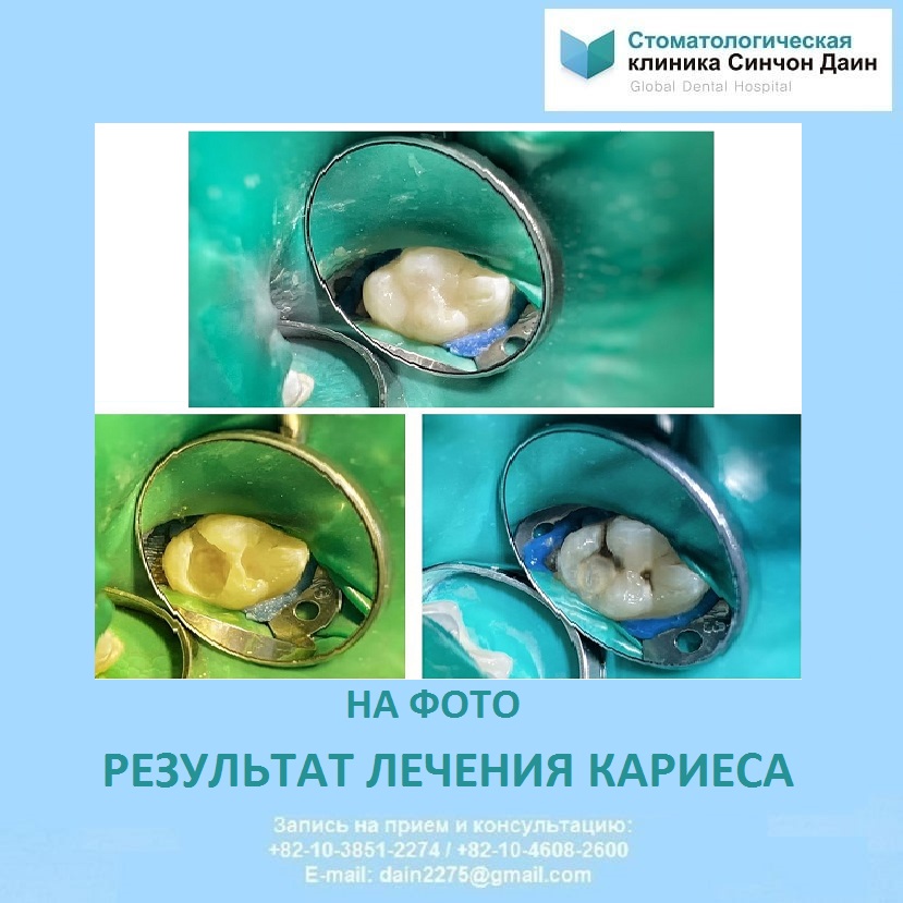 MariaDain's tweet photo. Обратите внимание,как сильно заболевание разрушило зуб,ведь внешне все выглядело как небольшие темные пятна на эмали.Появление мелких дырочек в зубах.Проявл��ние любого из этих симптомов-повод срочно записаться на осмотр к стоматологу.#sinchondain #Korea #koreandental #충치치료 https://t.co/DX2t7t5J46