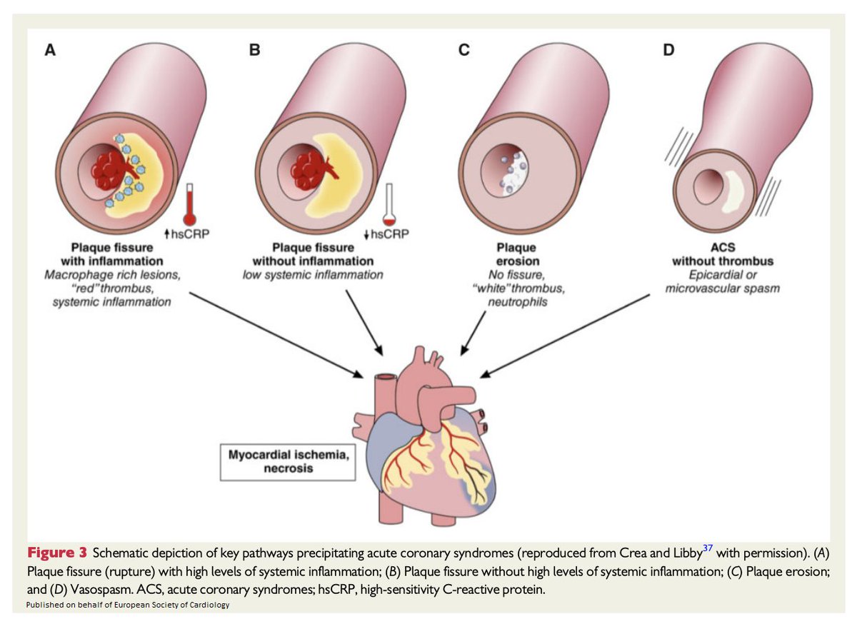 ESC_Journals's tweet image. Targeting #cardiovascular inflammation: next steps in clinical translation bit.ly/3ad1ReC

@escardio #EHJ #ESC_Young #cardiotwitter @ehj_ed