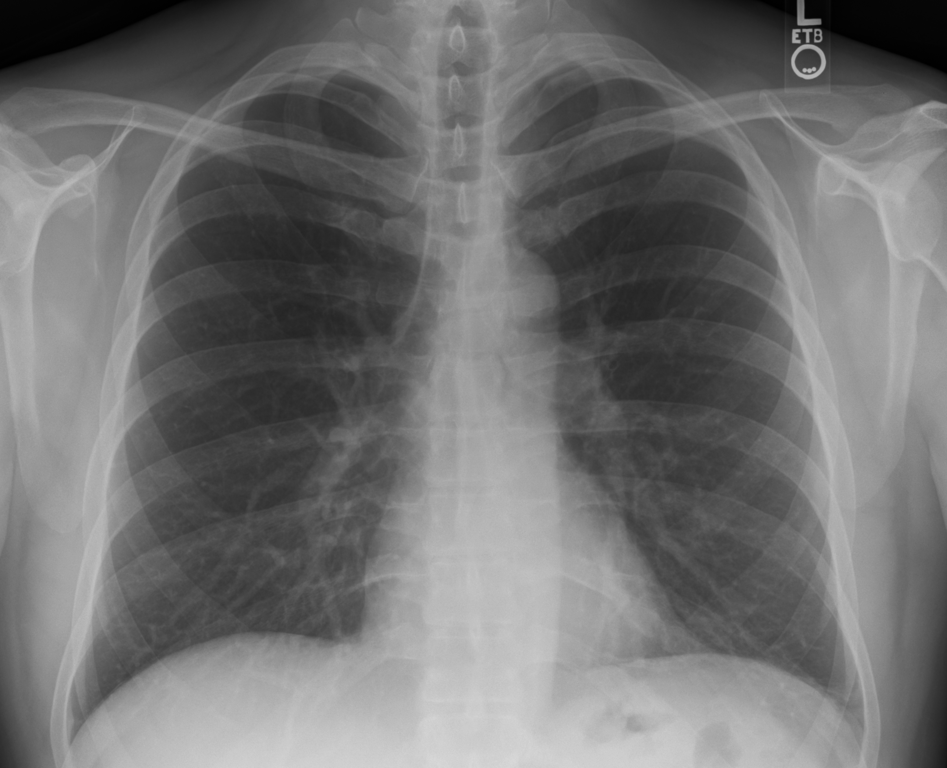 medicare_ltd's tweet photo. Free online event > Back to Basics: How to report a chest x-ray

Consultant radiographer Nick Barlow will be holding this new free virtual event on Monday, 17 August at 8pm.

More info> https://t.co/VIGKC1yL8g

#radiography #radiographer #radiographers https://t.co/Uqr5PmvNYL