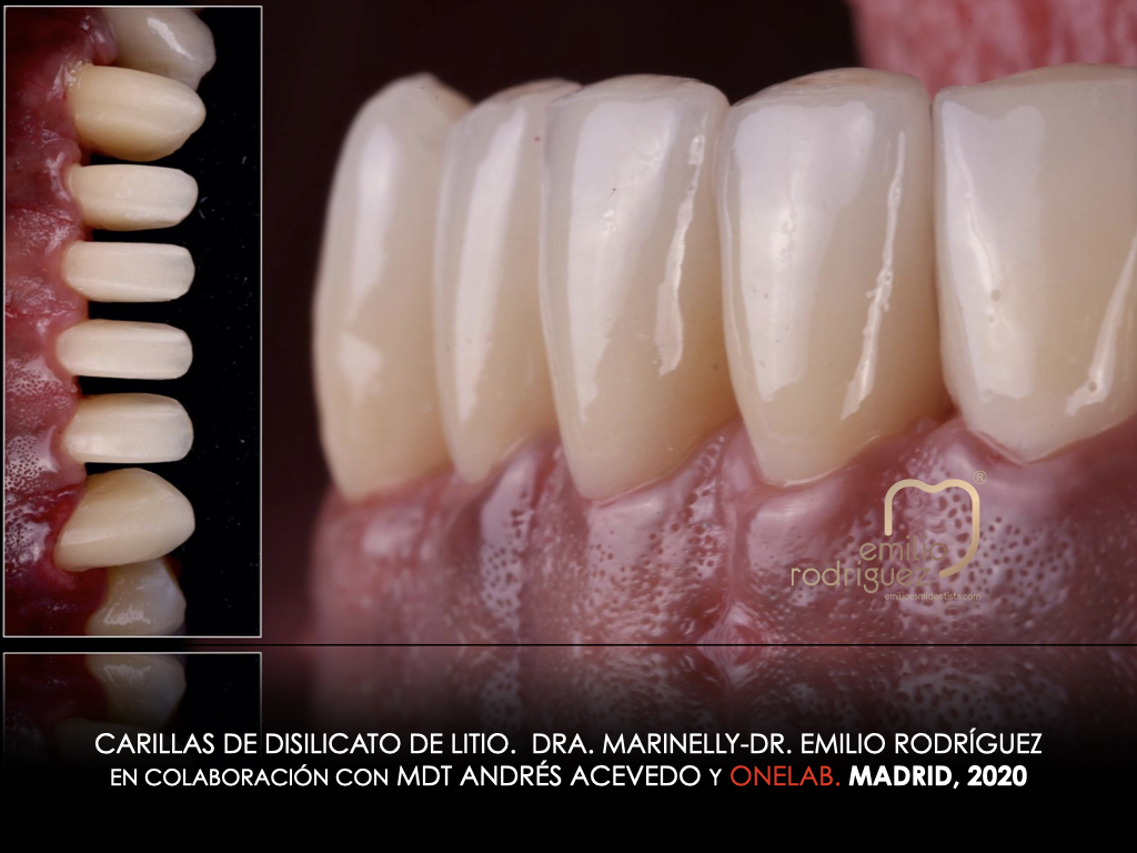 DDS_Rodriguez's tweet photo. Tissue harmony between the restorations (Veneers by ONELAB®) and the gums. #multidisciplinar approach and amazing team with Dra. Marinelly Mendes. Ronda de Segovia 31, 28005. Madrid. contacto@emilioesmidentista.com https://t.co/uJ8DPJcyog