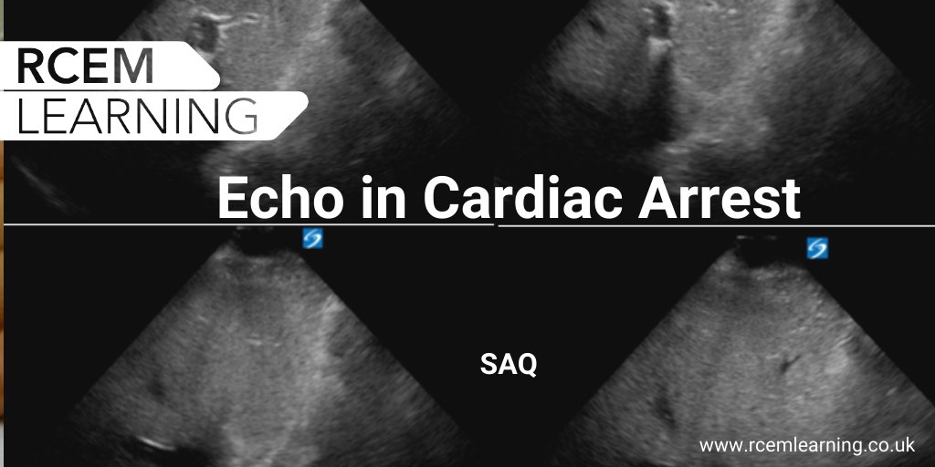 RCEMLearning's tweet image. A 45 y/o male is pre-alerted and brought to the ED following a witnessed out-of-hospital cardiac arrest..

We have a new SAQ from @NishCherian &amp;amp; @EveryOneNoOne1 with plenty of additional FOAMed resources. Check it out here 👉bit.ly/3kE8Thm #ELS