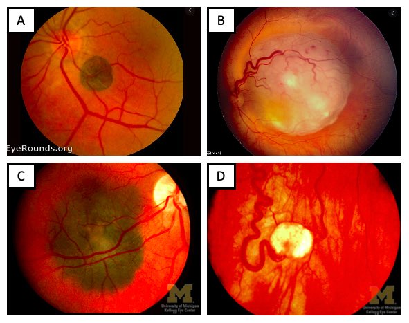 Can you match the fundus photos to the tumor/mass/lesion? Choices are: Retinoblastoma, CHRPE, melanoma, retinal hemangioblastoma. Check out the answers at lensophthalmology.com/question-of-th… #MedTwitter #Ophthalmology 
Thanks to <a href="/UMKelloggEye/">U-M Kellogg Eye Center</a> <a href="/EyeRounds/">EyeRounds</a> for images!