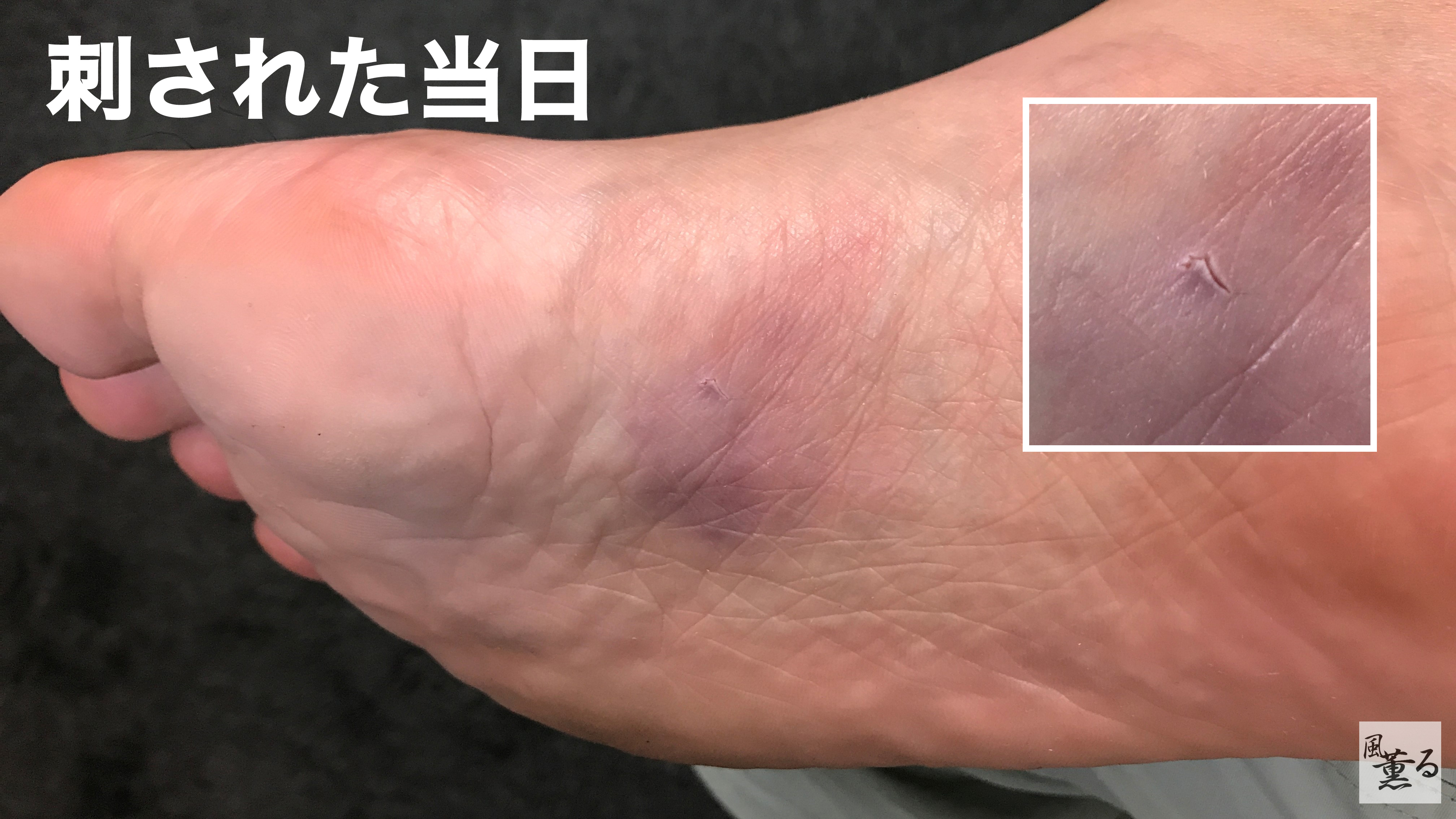 風薫る エイに刺される 8 2の東京湾ウェーディングでエイに刺された 幸い極々軽傷ですんだもののエイ 針の貫通力を実感する事となった 刺された場所が腫れや化膿する事も無かったが3日程僅かに鈍い痛み放ち紫色をしていた 現在は1cm程のシコリはあるものの