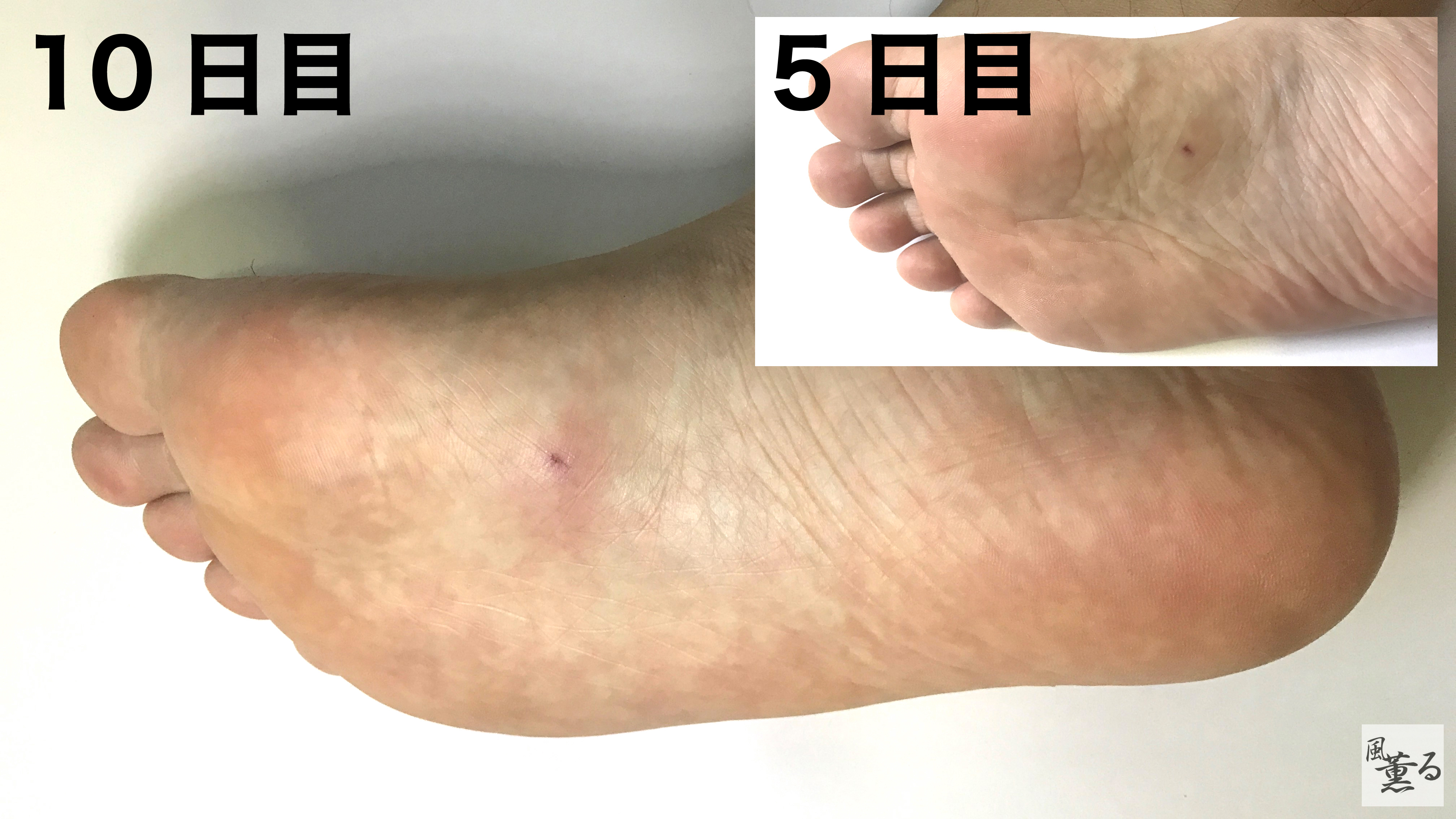 風薫る エイに刺される 8 2の東京湾ウェーディングでエイに刺された 幸い極々軽傷ですんだもののエイ 針の貫通力を実感する事となった 刺された場所が腫れや化膿する事も無かったが3日程僅かに鈍い痛み放ち紫色をしていた 現在は1cm程のシコリはあるものの