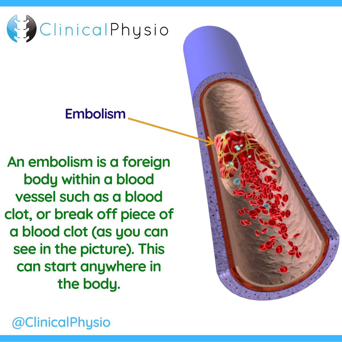 clinicalphysio's tweet photo. 💥 WHAT YOU NEED TO KNOW ABOUT EMBOLIC STROKES 💥
#stroke #strokephysio #neurophysio #strokerehab #cva #neurology https://t.co/pG5waa2QqA